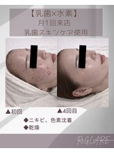 リグレア 浦安(Re.GLARE)/ニキビ、ざらつき