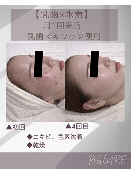 リグレア 浦安(Re.GLARE)/ニキビ、ざらつき