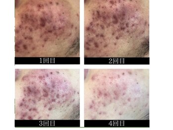 ビューティーケア(beauty care)の写真/毛穴レス肌へ☆ニキビ・毛穴に特化したハーブピーリングで自信あふれる透明感◎