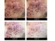 ビューティーケア(beauty care)の写真/毛穴レス肌へ☆ニキビ・毛穴に特化したハーブピーリングで自信あふれる透明感◎