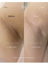 エルビービュティーサロン(LB BEAUTY SALON)/【ルメラ乳輪】実績数関西1★