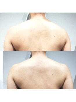 RiとBiのたまご/（ブライダル）1回before-after