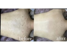 レシェルサロン(Lechelle Salon)/背中ハードハーブピーリング