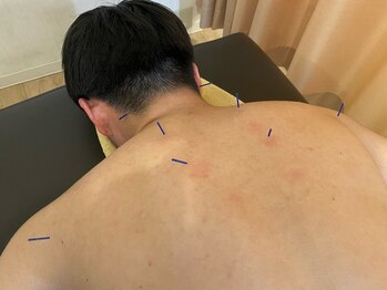 マイストレッチ 桜木町店(My Stretch)の写真/当店の人気メニュー！【初回限定】辛い首・肩こり改善に◎15分鍼灸+70分ストレッチ整体：計85分¥7370