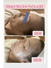 カラーリリー(calla lily)/ウルトラリフトの効果