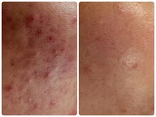 ベルドア(Bell Door)/ハーバルピーリング