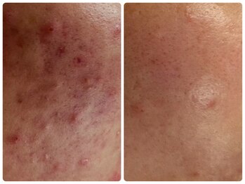 ベルドア(Bell Door)/ハーバルピーリング