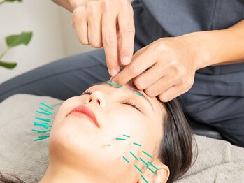 ナギ鍼灸院(nagi鍼灸院)の写真/【自分史上No.1☆小顔・リフトアップ/美容鍼】むくみ・コリを解消しハリ艶感UP★理想のフェイスラインへ!