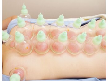 ティグリス(TIGRIS)/カッピング