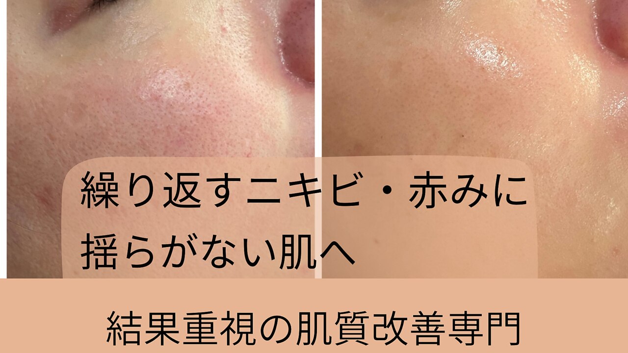 肌質改善エステサロン♡ アリィ(Alii hisaya)｜ホットペッパービューティー