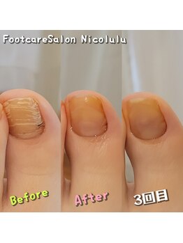 分厚い爪ビフォーアフター