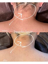 ラルタン(LARUTAN)/うなじ脱毛のビフォーアフター◎