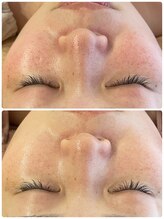 ロッシュ フェイス(Roche Face)/20代女性