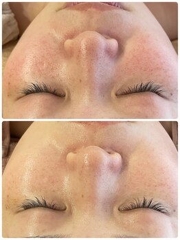 ロッシュ フェイス(Roche Face)/20代女性