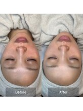 ホワイトアクア 天王寺本店(WHITE AQUA)/ララピール/大阪/天王寺/小顔