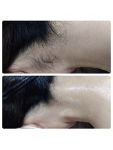 ルアナ(Luana)/まとめ髪の季節に！うなじ脱毛♪