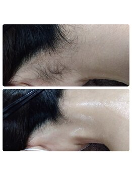 ルアナ(Luana)/まとめ髪の季節に!うなじ脱毛♪