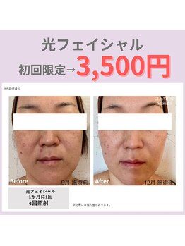 ルナ(Runa)/光フェイシャルでトーンアップ