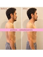 ポルクス鍼灸整骨院 表参道(Pollux鍼灸整骨院)/EMS ビフォーアフター