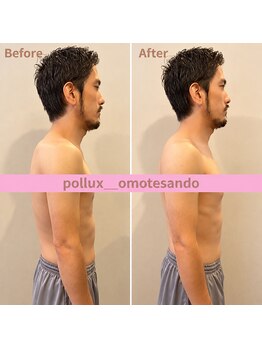 ポルクス鍼灸整骨院 表参道(Pollux鍼灸整骨院)/EMS ビフォーアフター