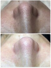 エアリアル 玉名店/鼻の毛穴汚れ、黒ずみスッキリ！