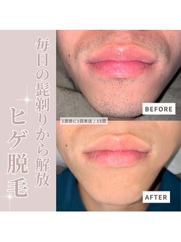 メンズラボ 京都駅前店/脱毛×美肌の最新脱毛機