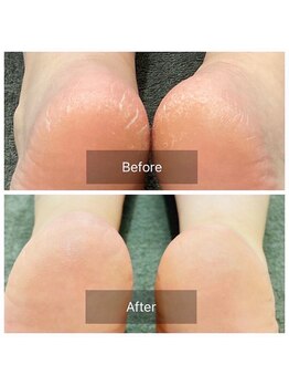 リアン(Lien)/before after