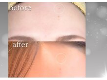 ソナ 大和西大寺院(SONA)/シミやホクロはお顔のノイズに。