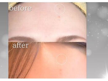 ソナ 大和西大寺院(SONA)/シミやホクロはお顔のノイズに。