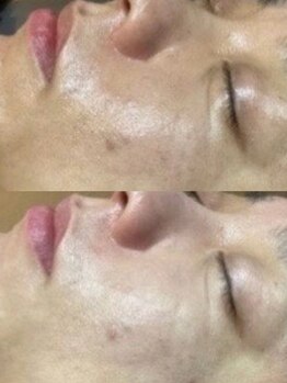 ドットフェイス(.Face)/before/after