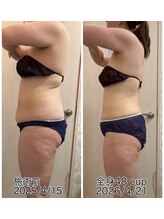クールスパ(COOL SPA)/40代女性 お腹症例