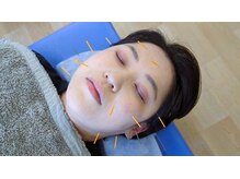 富山ふじい鍼灸整体院/肌質改善に美容鍼