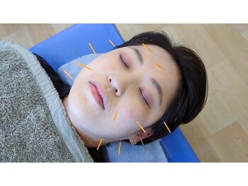 富山ふじい鍼灸整体院/肌質改善に美容鍼