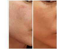 ジーニー(Genie)/驚愕！！！肌質の「変化」に注目