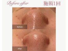 パルタージュ 三宮(Partage)/毛穴洗浄体験