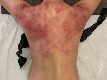 エクラ(eclat)の写真/【ジムは続かないが吸引は抵抗がある方】セルクラは肩こり改善+ウエスト引締めに特化!集まりが多い季節に