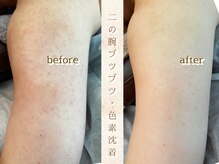 ホウビ(HOUBIE)の雰囲気（医療でも改善が難しい二の腕毛孔性苔癬。。改善プランもあります）