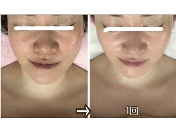アルページュ(Arpege)の写真/仙台初♪韓国話題★エステ版チタニウムリフト【小顔輪郭×高ハリ×色白×毛穴レス】一度で叶う欲張り美容