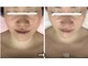 アルページュ(Arpege)の写真/仙台初♪韓国話題★エステ版チタニウムリフト【小顔輪郭×高ハリ×色白×毛穴レス】一度で叶う欲張り美容
