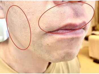 フィズ 浦和店(FIS)/☆脱毛途中経過［浦和/顔脱毛］