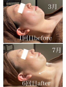 イーストモア(EAST MOIS)/W光フェイシャル6回継続した結果