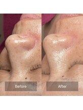 ミースリーズ(methrees)/トーンアップ&シミ対策