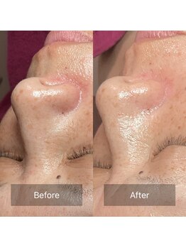 ミースリーズ(methrees)/トーンアップ&シミ対策