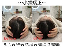 エール シガ(AILE SHIGA)/【小顔矯正】