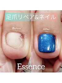 食い込み予防,改善ケア＋リペア