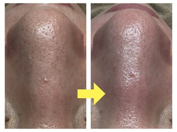 アルマ(ALMA)/毛穴に汚れを溜めない美肌習慣