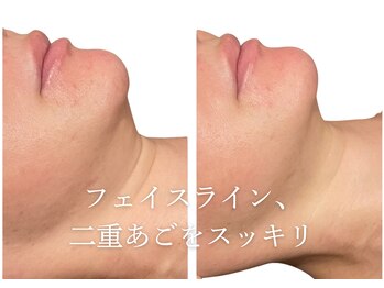 アマランサス(Amaranthus)/二重あご、むくみにも