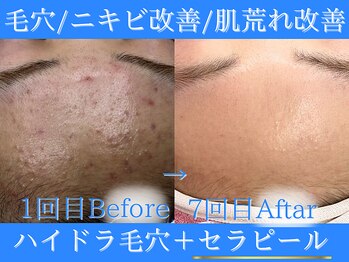 Cスキンケアクリニック 麻布店/ハイドラ毛穴+韓国セラピール