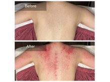 ユギカッサでの老廃物促進★【むくみ/デトックス/冷え性改善】