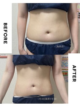 ホソナル(HOSONAL)/コツコツダイエット